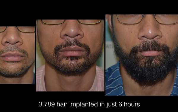 Beard Surgery
