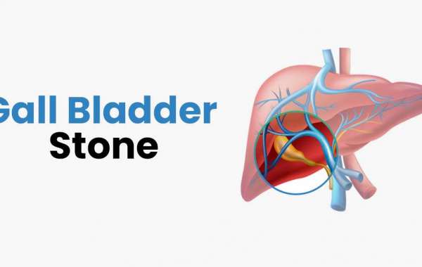 How Risky is Gallbladder Stone (Gallstones)?