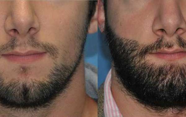 Cuánto Cuesta Un Implante De Barba