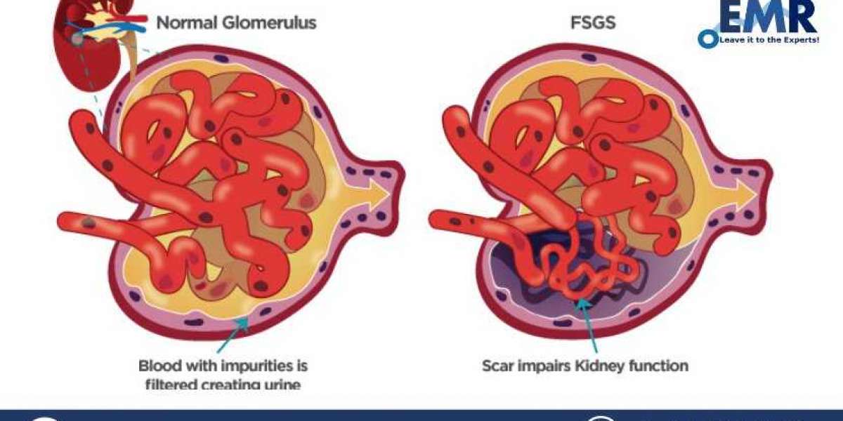 Focal Segmental Glomerulosclerosis (FSGS) Treatment Market Size, Price, Share, Trends, Growth, Report and Forecast 2023-