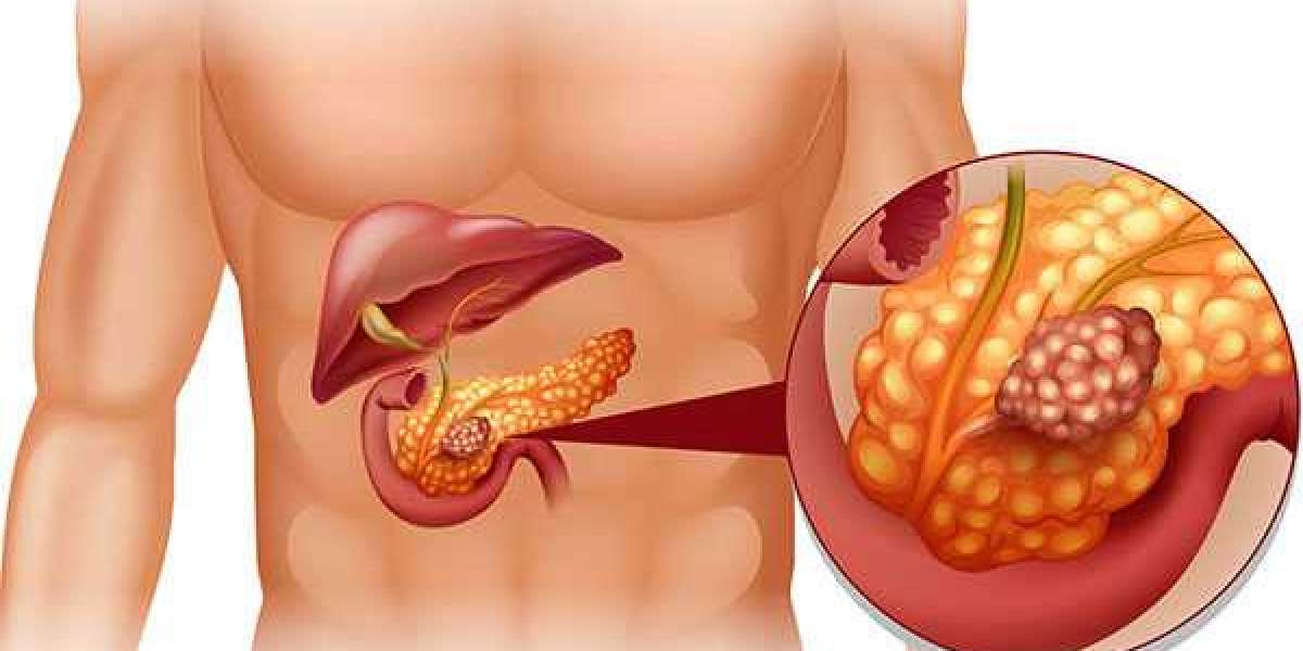 Pancreatic Cancer: A Grave Complication of Pancreatitis Disease