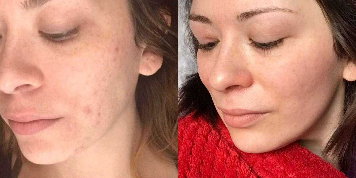 Does your acne come back after Accutane?