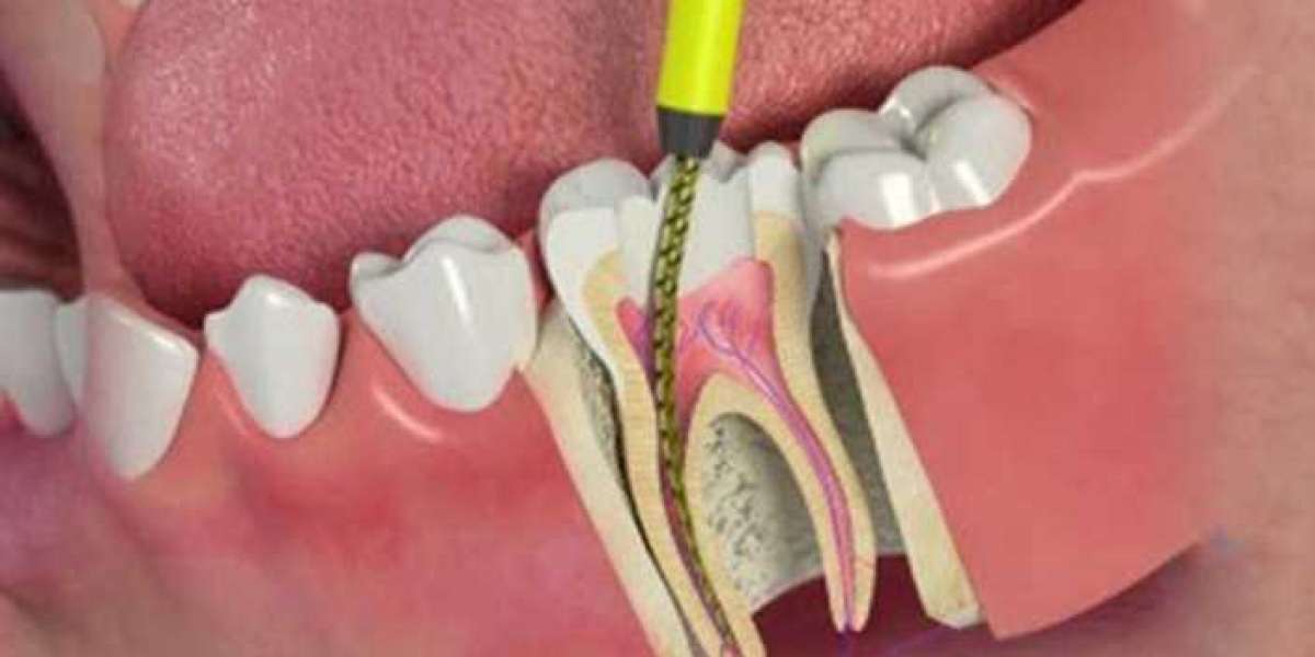 Remarkable Root Canal Treatment Cost in India
