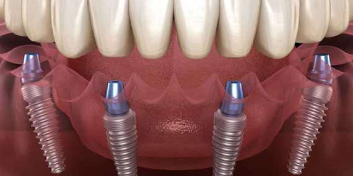 Get Your Best and Affordable Dental Implants In Gurgaon