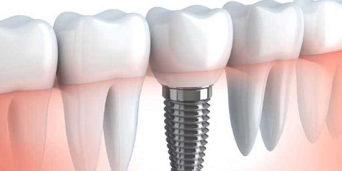 Get The Best Cost of Dental Implants in India