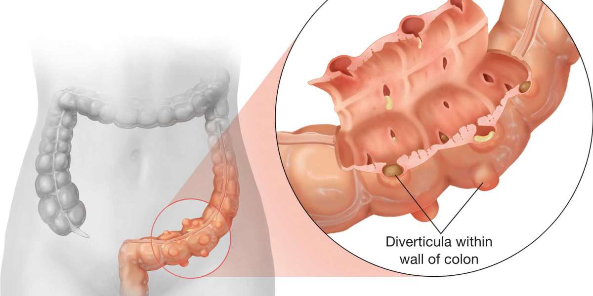 Diverticulitis Perspectives: Market Trends and Research Insights | DLI