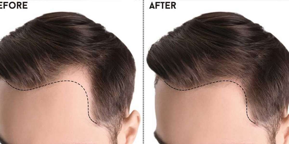 Revitalize Your Look: A Comprehensive Guide to Hair Transplant in Islamabad