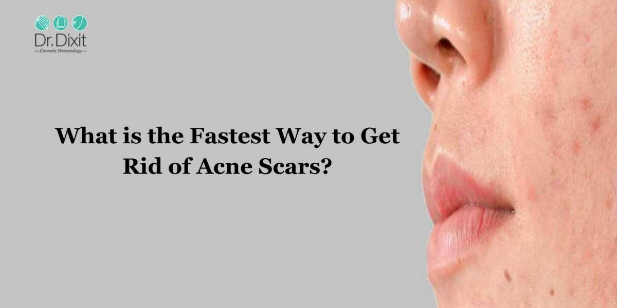 What is the Fastest Way to Get Rid of Acne Scars?