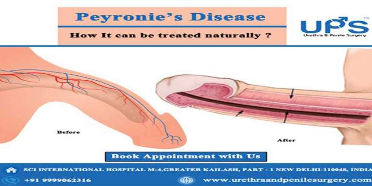 Top Specialists in Delhi: Peyronie's Disease