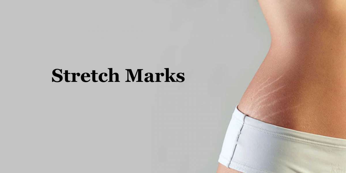 How to Get Rid of Stretch Marks?
