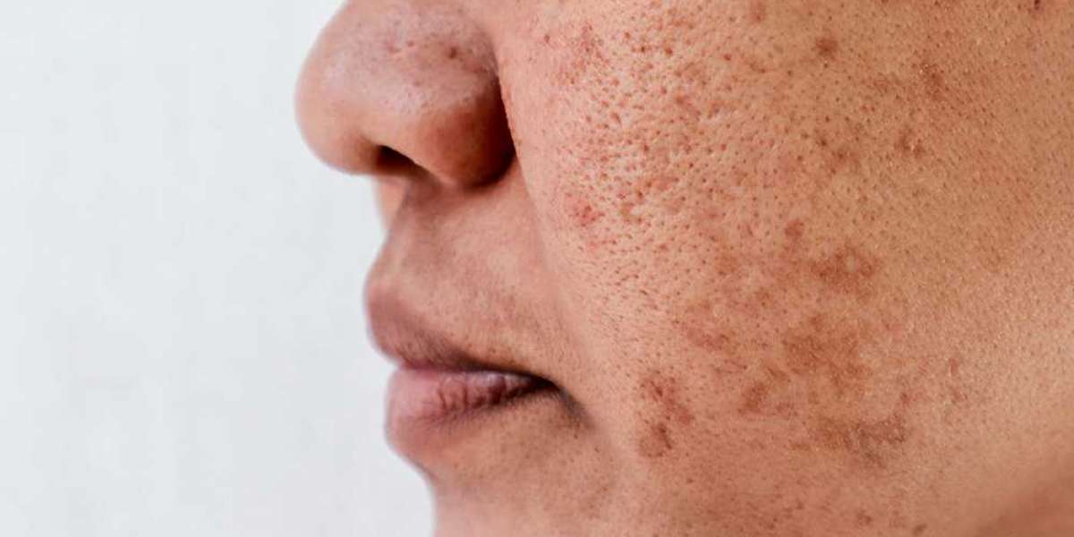How do you fix pigmentation on your nose?