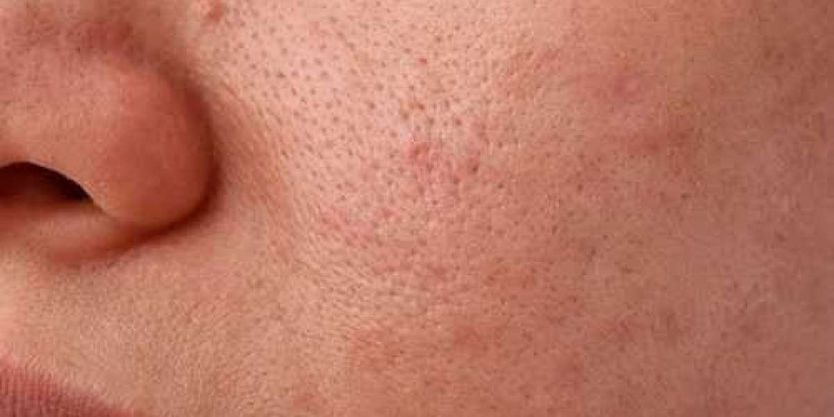 Everything You Need To Know About Open Pores On the Face
