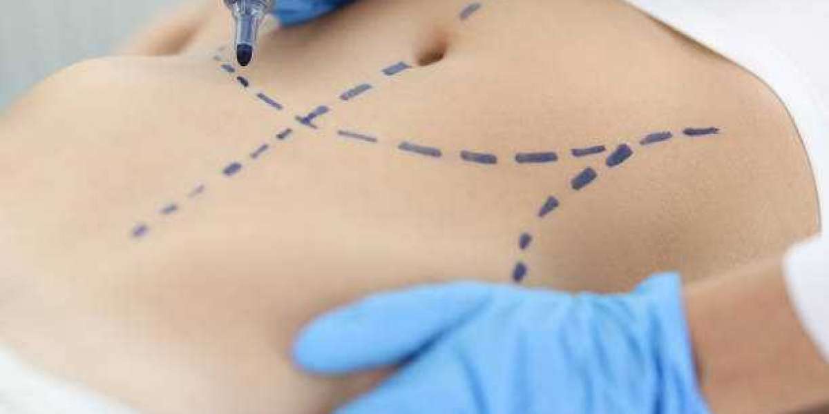 Dubai's Liposuction Revolution: The Latest Techniques and Trends