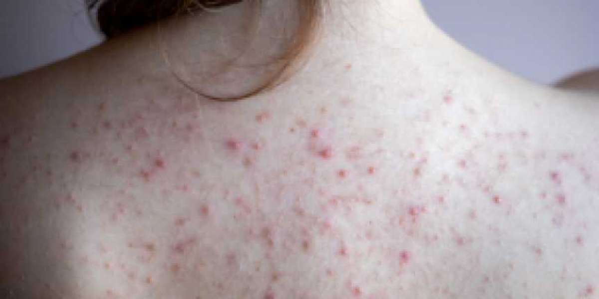 All About Back And Body Acne: Causes And Treatments