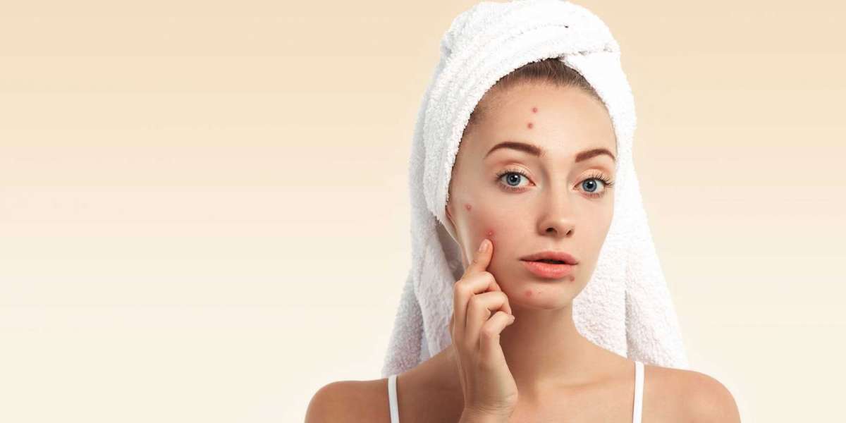 Understanding The Causes of Acne