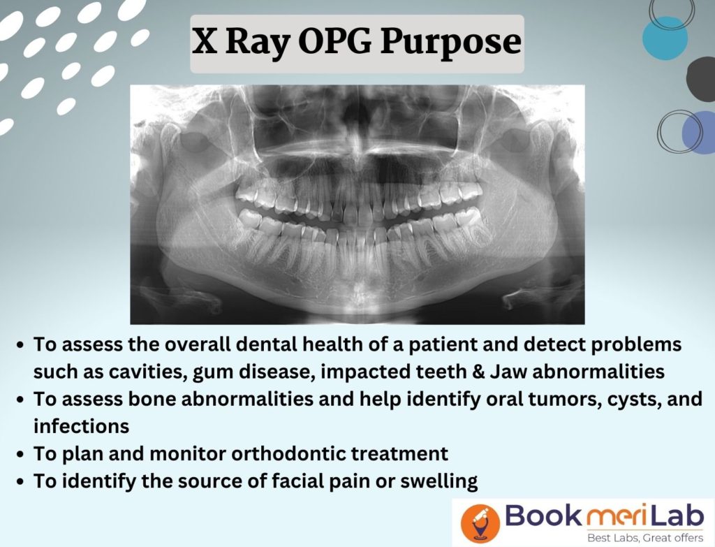 OPG X-Ray: Get Price, Purpose, Results & Sample Report [2024]