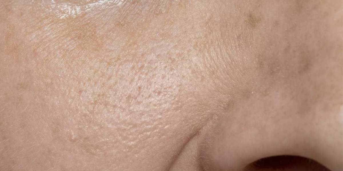 Causes of Open Pores You Didn’t Know About