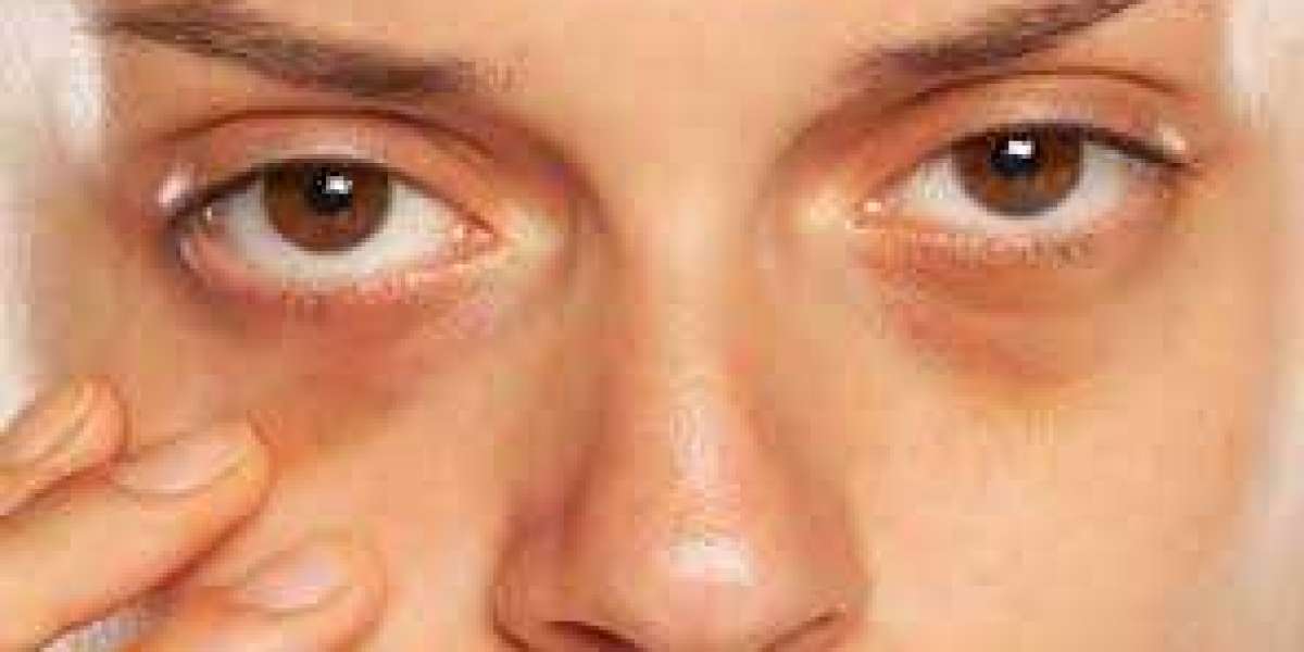 How To Get Rid of Dark Circles Under the Eyes?