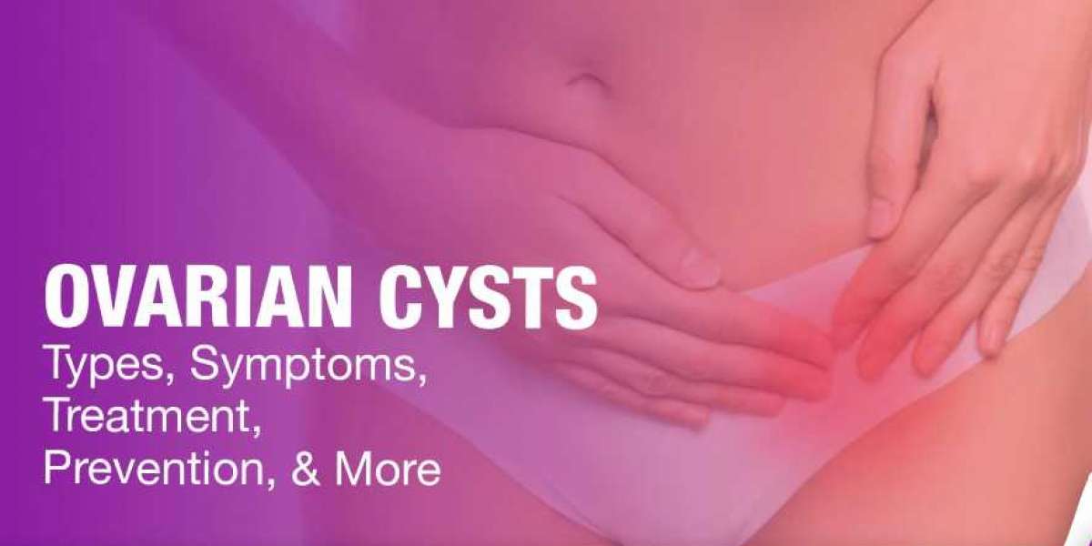 Ovarian Cyst Treatment in Gurgaon