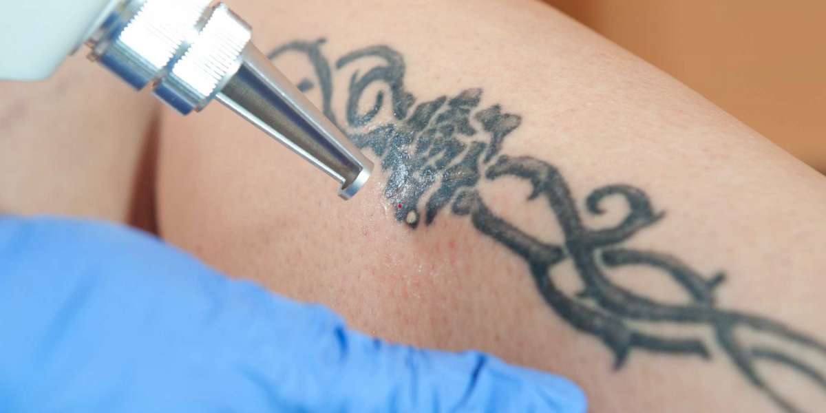 Tattoo Removal Market Share, Industry Growth, Trends and Forecast 2024-2032