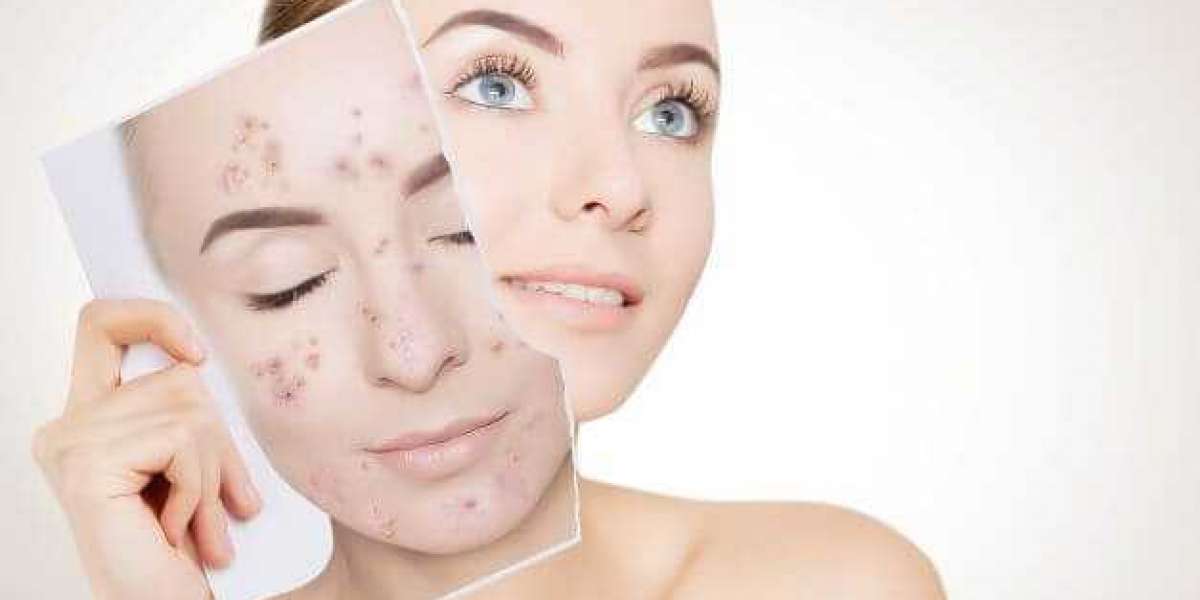 Using Isotretinoin the Right Way for Acne