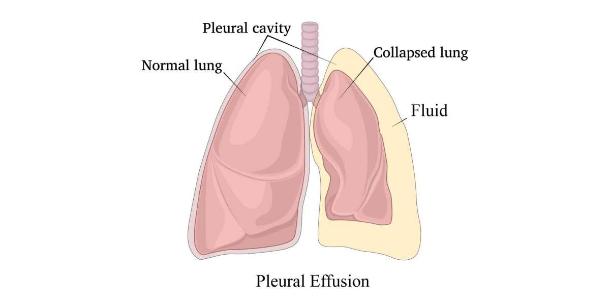 Pleural Effusion - Symptoms & Surgical Treatment