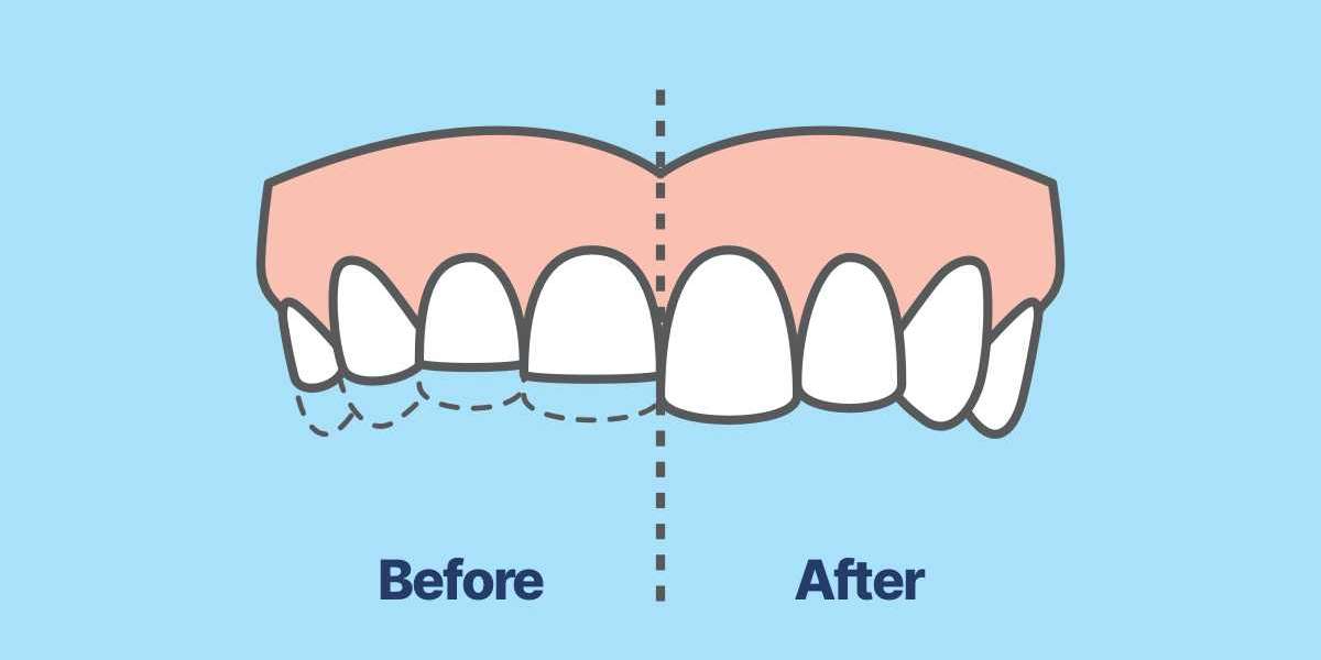 Managing Bruxism: Expert Tips from Fremantle's Teeth Grinding Specialist