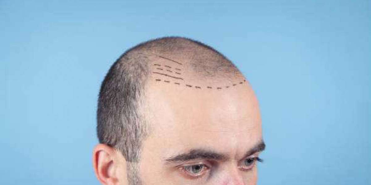 Hair Transplant Myths Debunked: What Riyadh Residents Should Know