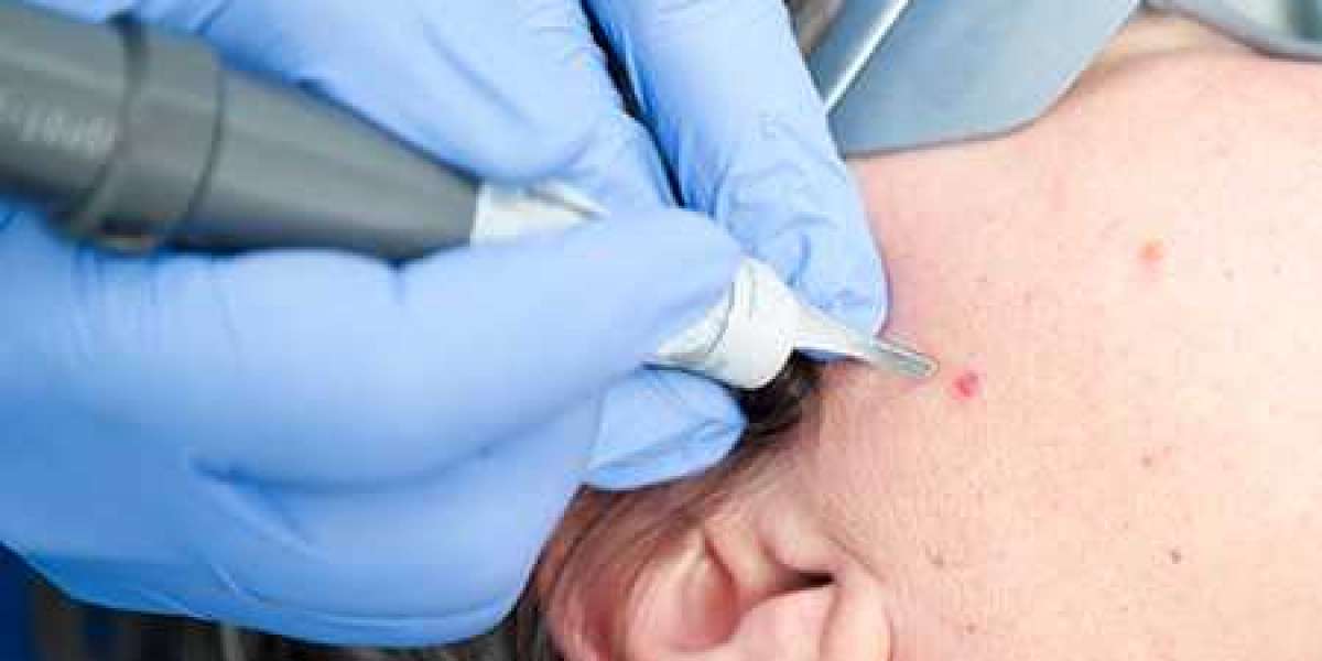 Things One Must Know About Removing Acne Scars With Lasers