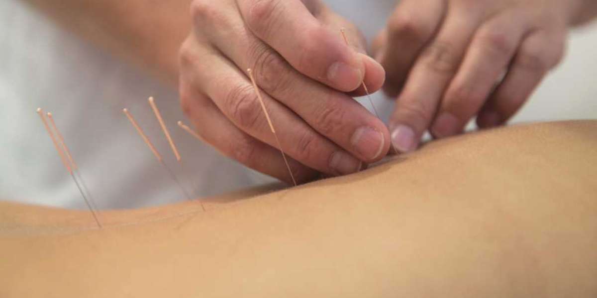 Acupuncture Therapy NYC