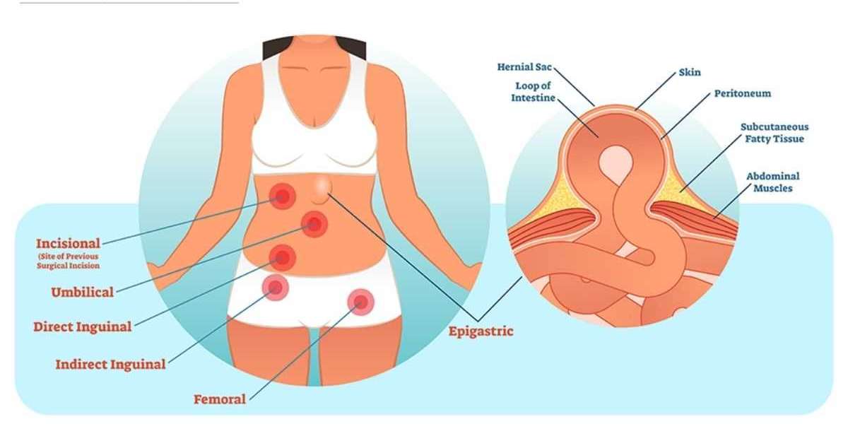 Hernia FAQs: Get Your Questions Answered