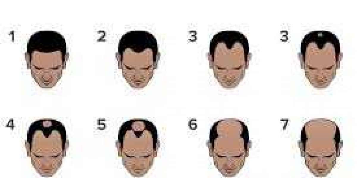 7 Stages of Hair Loss in Male