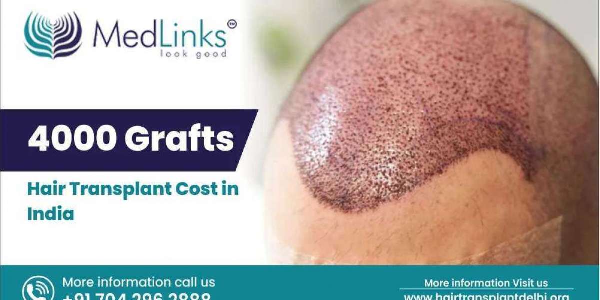 4000 Grafts Hair Transplant Cost in India 2024