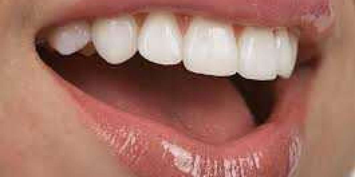 Transform Your Smile with Dental Veneers and Dental Laminates in Las Vegas