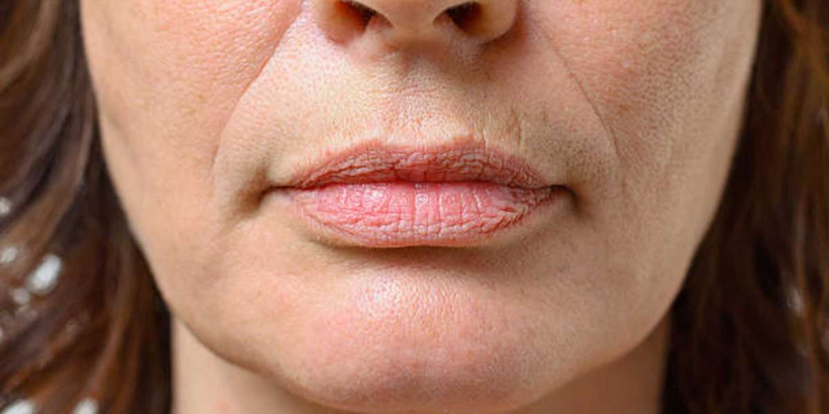 Nasolabial Lines Filler: Treatment Options and Results