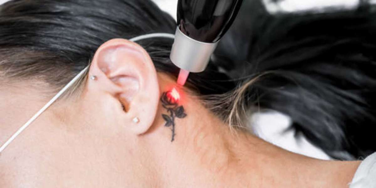 Tattoo Removal by Tattooing: A Comprehensive Guide