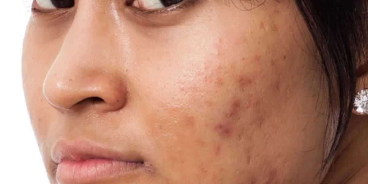 Ultimate Guide to Pigmentation Treatment Kits: Your Path to Clear, Even Skin