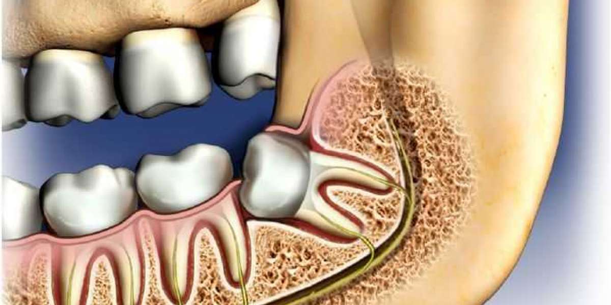 Expert Dental Care at MySilicon Valley: Dental Surgeon San Jose CA, Emergency Wisdom Teeth Removal San Jose, Sinus Augme