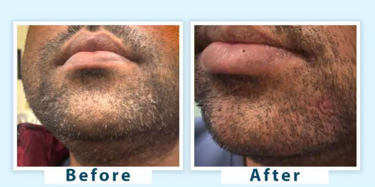 Effective Ways to Prevent Beard Greying Natural and Expert Solutions