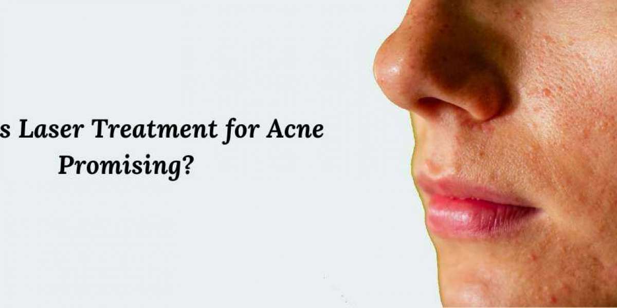 Why is Laser Treatment for Acne Promising?