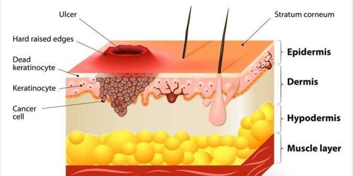 Squamous Cell Carcinoma Market Size, Share, Trends, Industry Analysis, Report 2024-2034