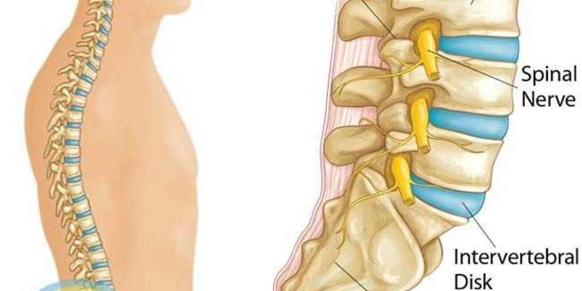 Spondylolisthesis Market Size, Industry Share, Trends 2024-34