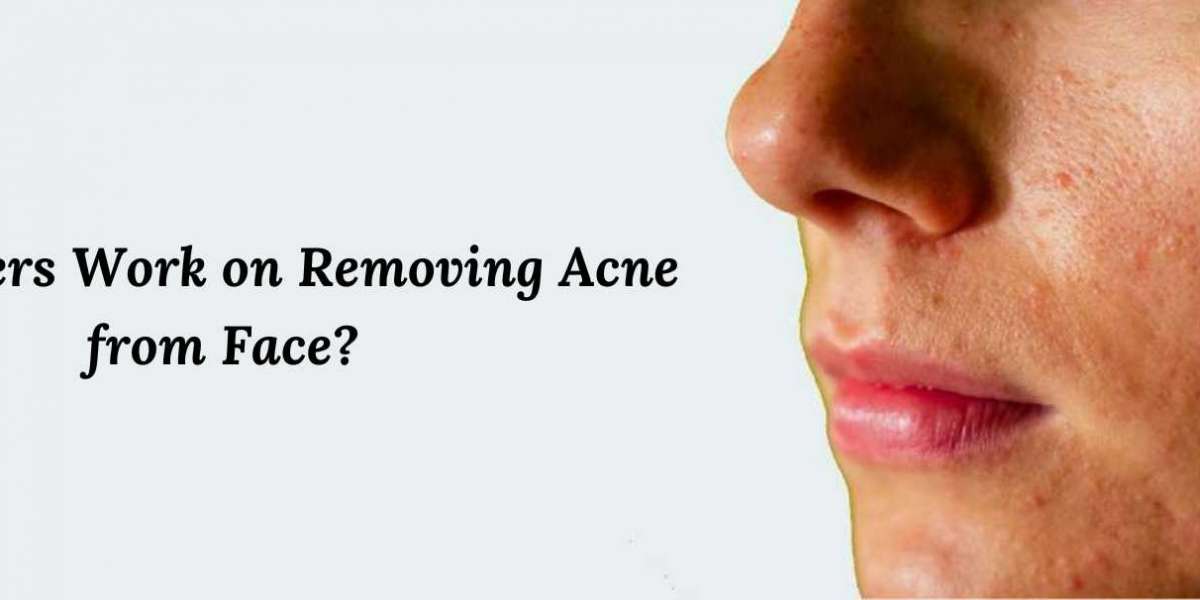 How Lasers Work on Removing Acne from Face?