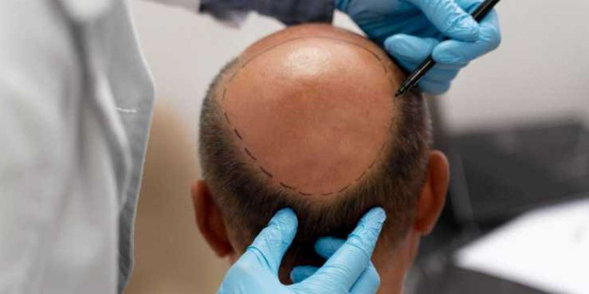 Is Male Pattern Baldness an Inevitable Part of Aging?