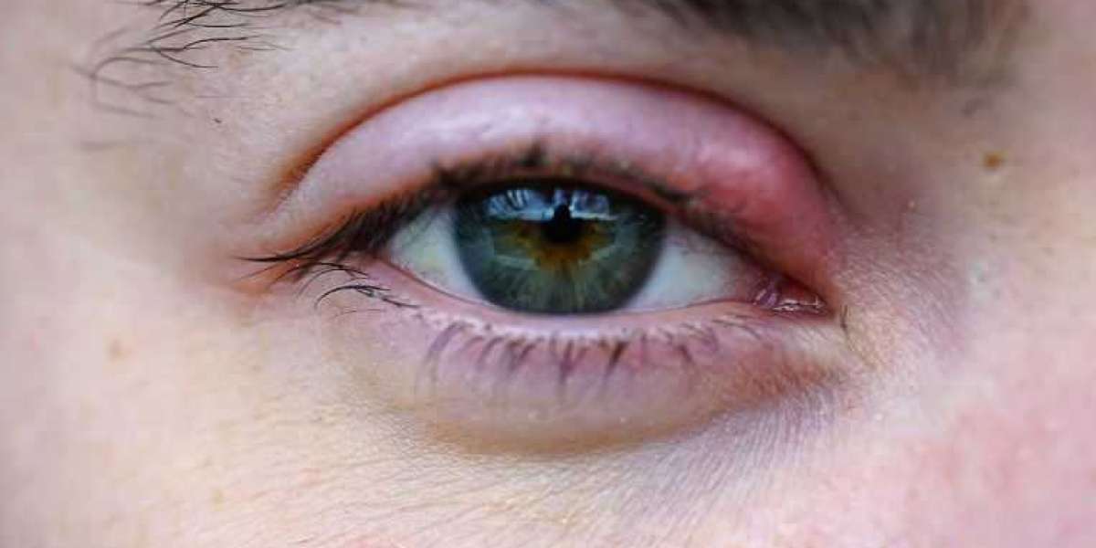 Chalazion NHS vs. Stye: Knowing the Difference