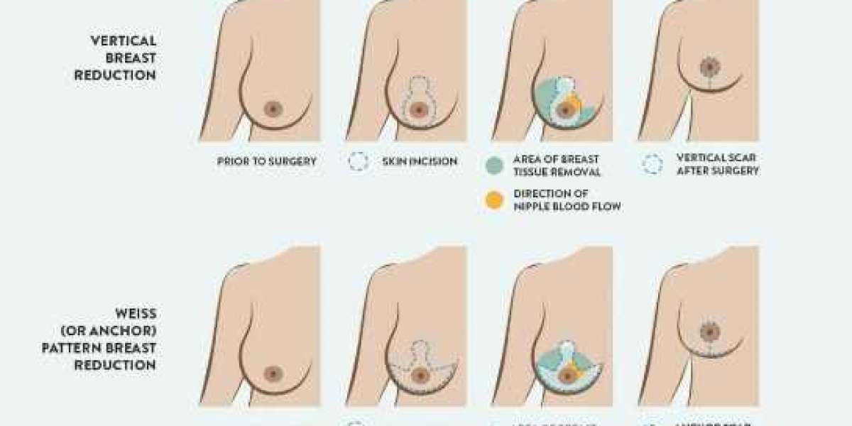 Breast Cancer Surgery in Pune - Choose Dr. Shilpy Dolas for precise and compassionate breast cancer surgery.