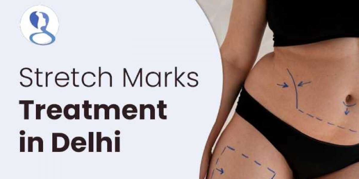 Effective Stretch Marks Treatment in Delhi: Restore Smooth, Healthy Skin