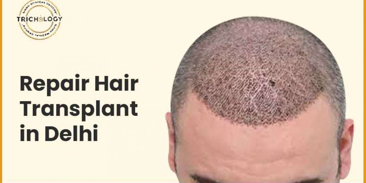 Why Did Your Hair Transplant Not Work?