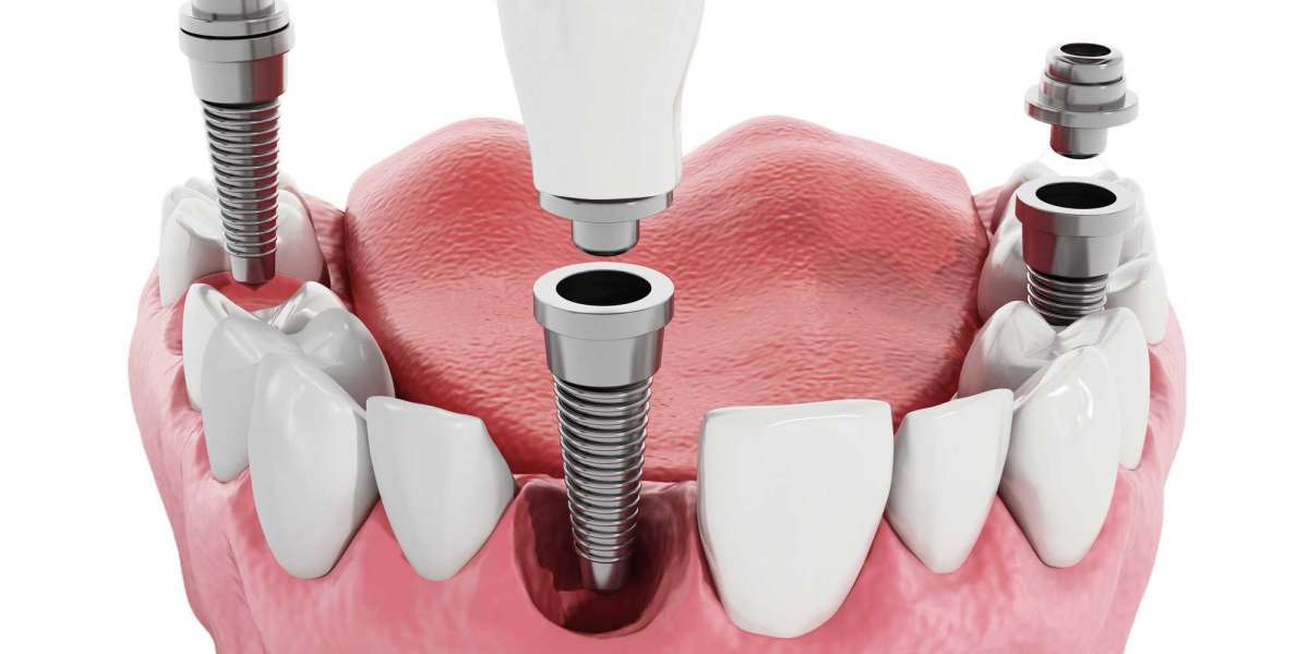 Dentures vs. Full Mouth Dental Implants: Which One Suits You Best?