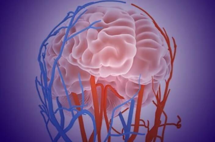 Brain Aneurysm Treatment Choosing the Right Approach for Your Condition